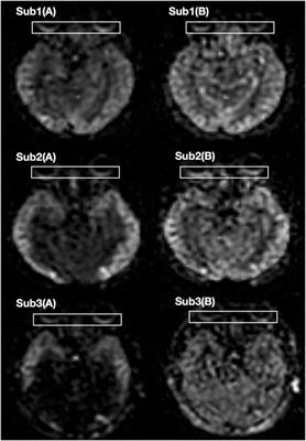 The effect of dobutamine on ocular blood flow of healthy adults: A 3D pseudocontinuous aterial spin labelling study